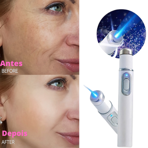 Caneta de laser para tratamento de varizes, acne e cicatriz.